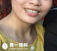 北大深圳医院，拔个牙竟然把我的门牙磕歪了