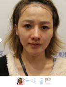  曝光一个植发骗子 植发的朋友注意别被骗了