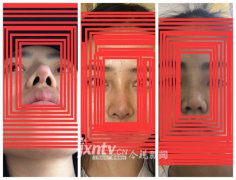 高价整出歪鼻子三姑娘投诉南昌禾丽医疗美容医院