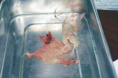 湖南湘雅博爱康复医院口腔手术10个月后伤口“长出”了纱布！